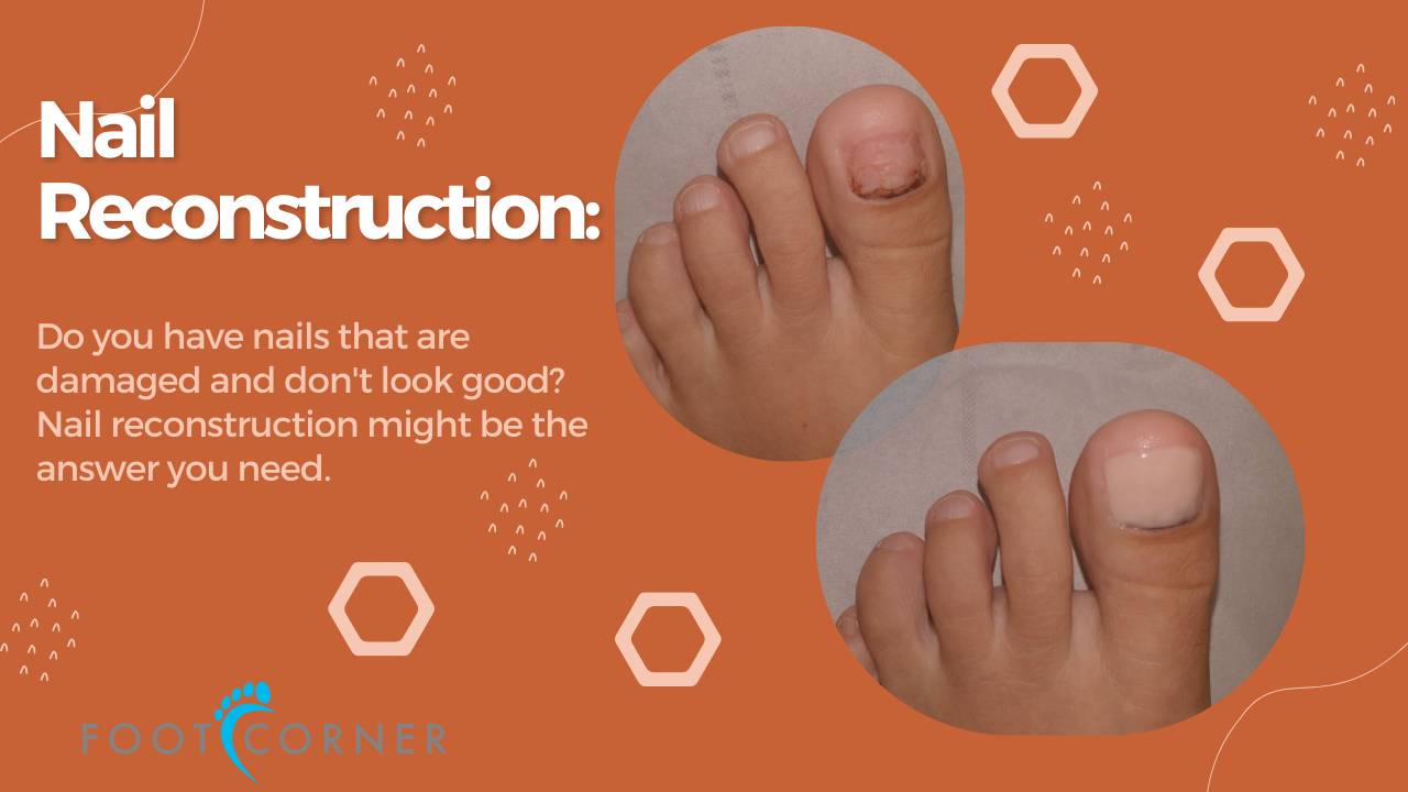 Damaged Toenails Looking Beautiful After Nail Reconstruction