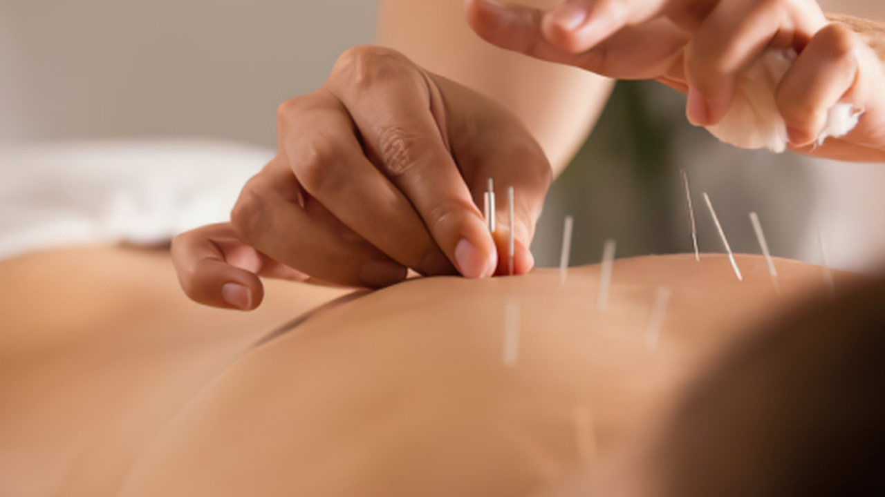 Acupuncturist needling a patient's back.