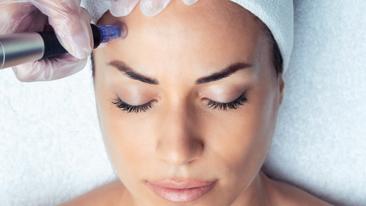 Microneedling Acupuncture in Oakland