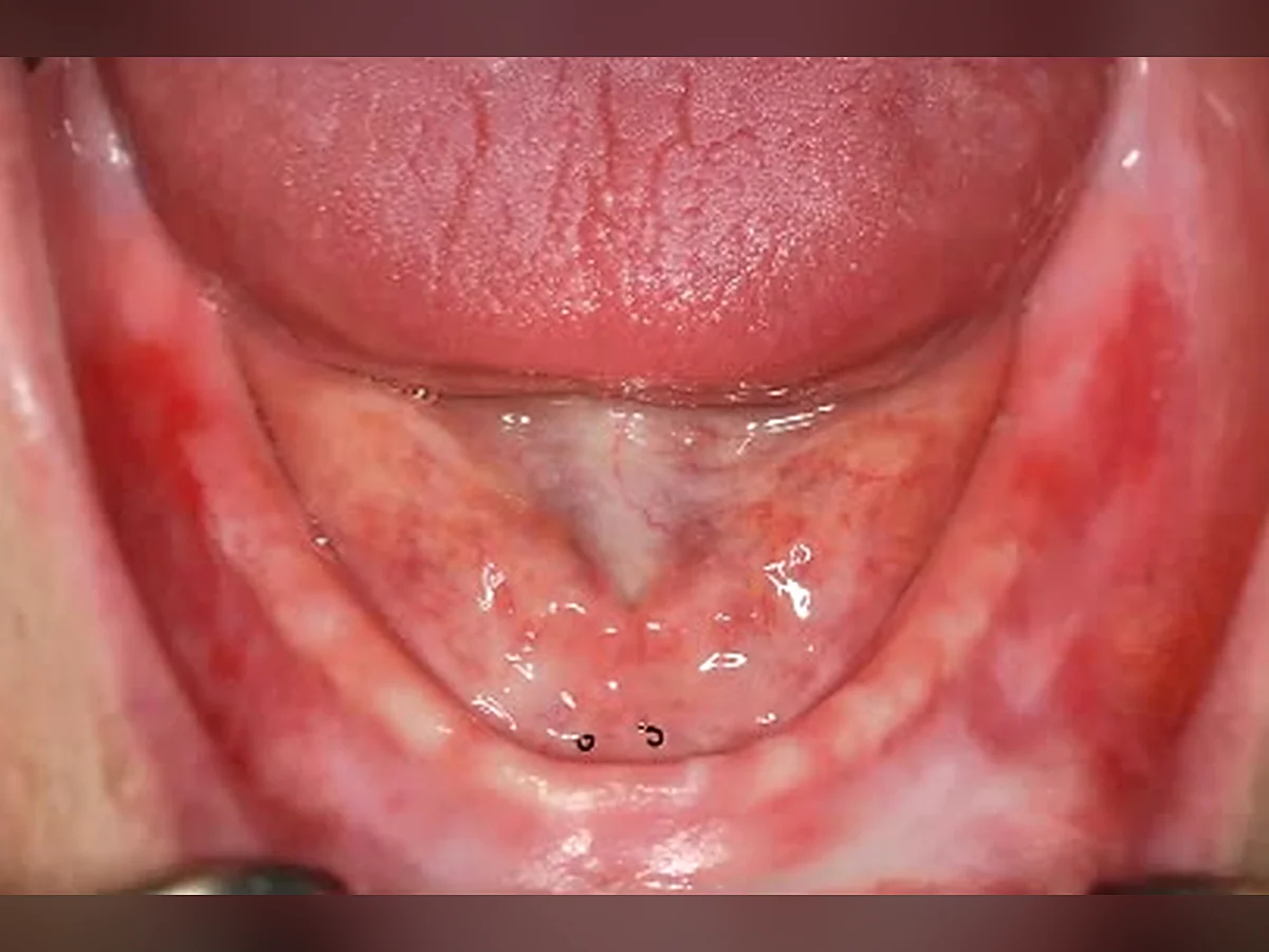 Reborde mandibular reabsorbido