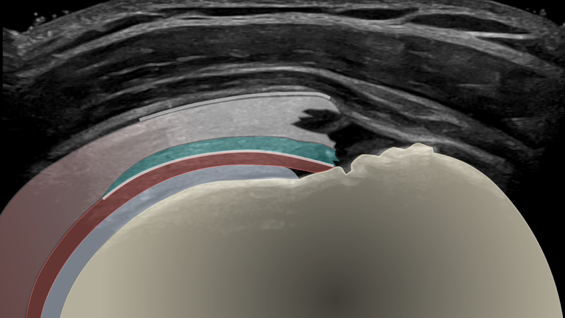 Cuff Tear