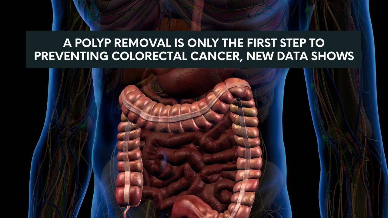 Colorectal Cancer Risk After Polyp Removal