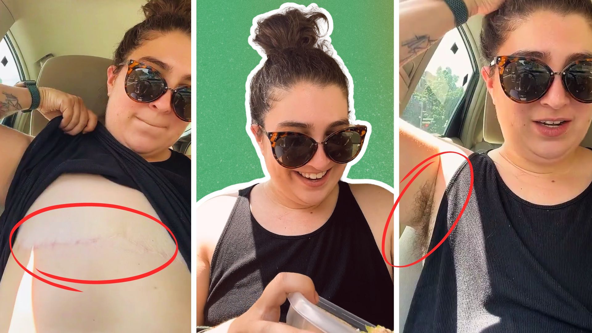 Embracing Body Autonomy: Hairy Pits and Top Surgery &mdash; blog post by Ren&eacute;e Yoxon