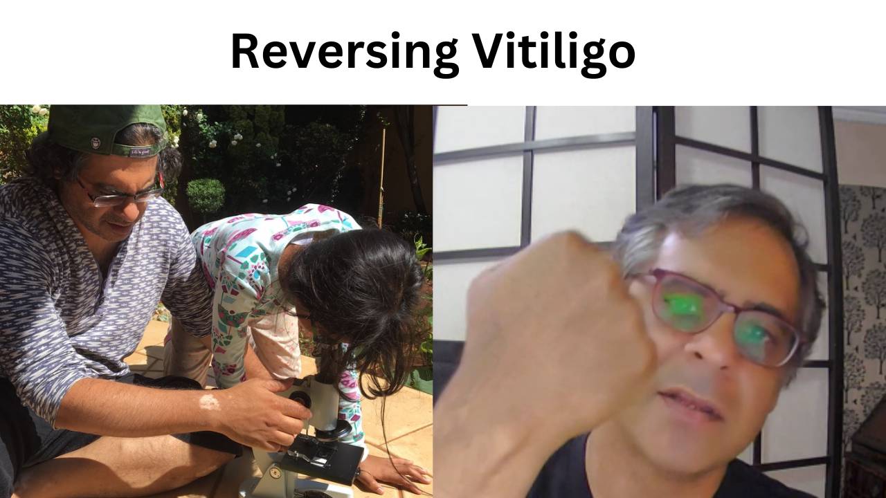 4 Week Course To Reverse Vitiligo And Other Autoimmune Disease