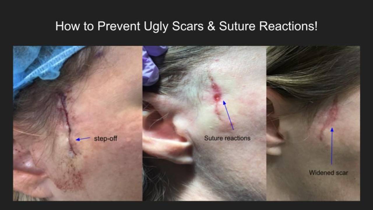 How to Prevent Ugly Scars & Suture Reactions