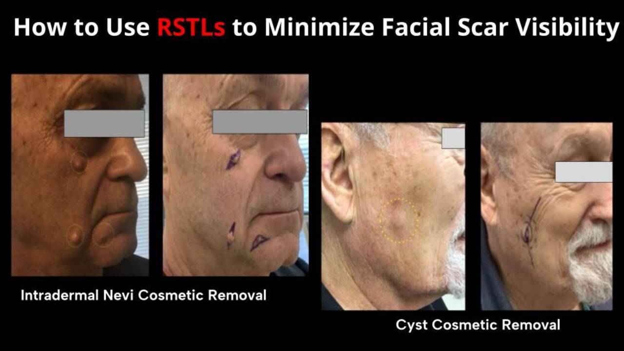 Resting Skin Tension Lines for Facial Skin Surgery to Minimize Scars