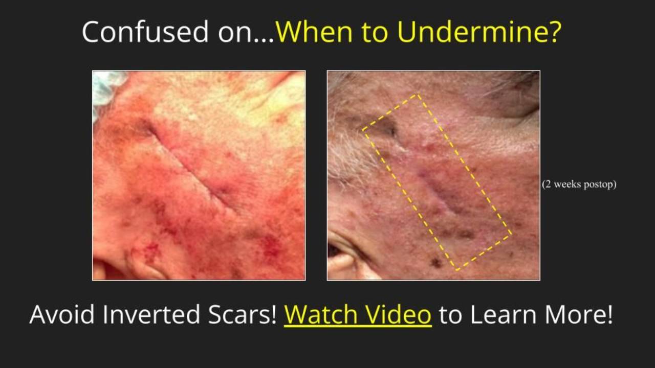 Understand Undermining