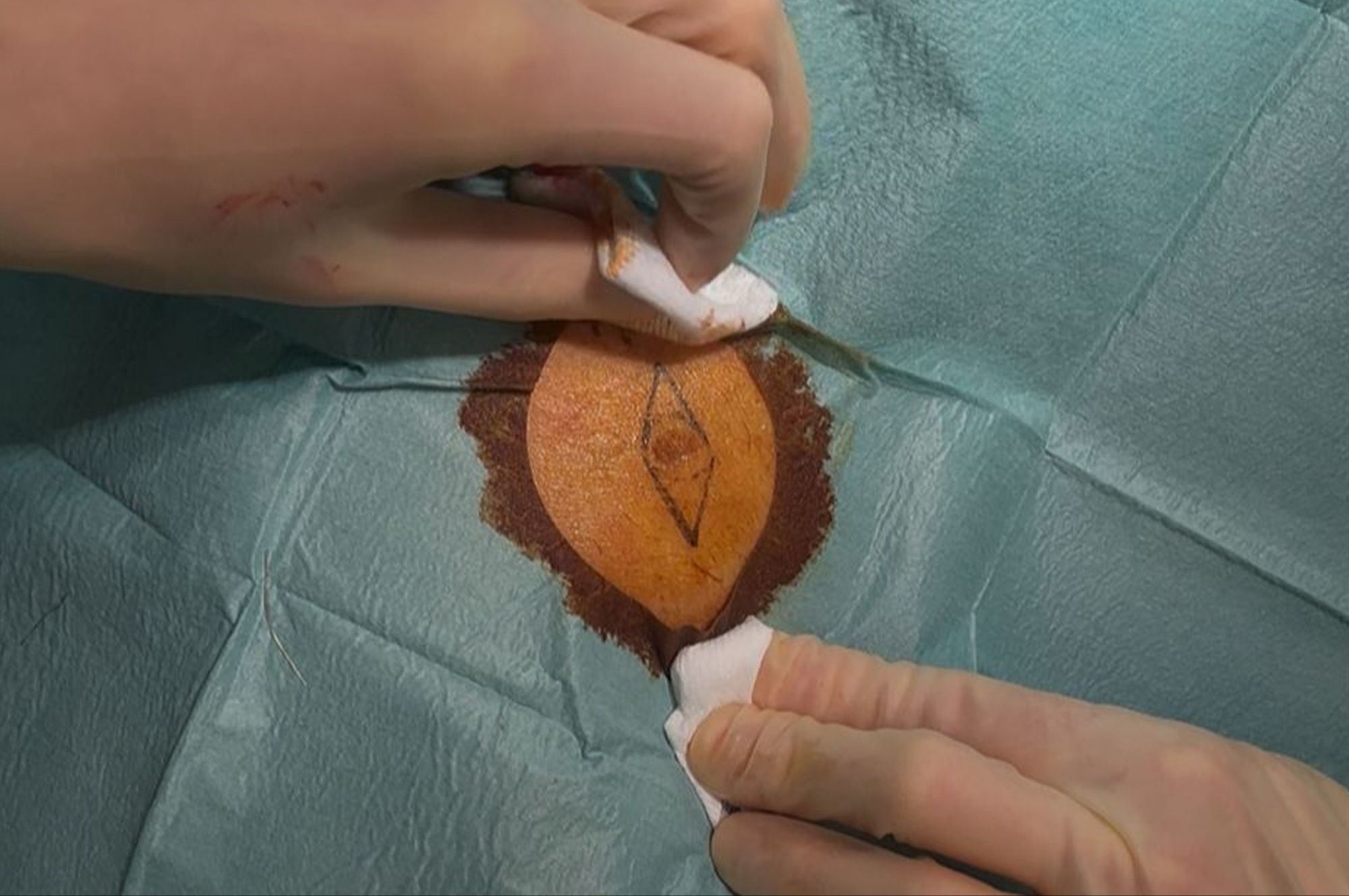 Certificate of Advanced Skin Cancer Medicine & Surgery - Part 1 (Theory, Online)
