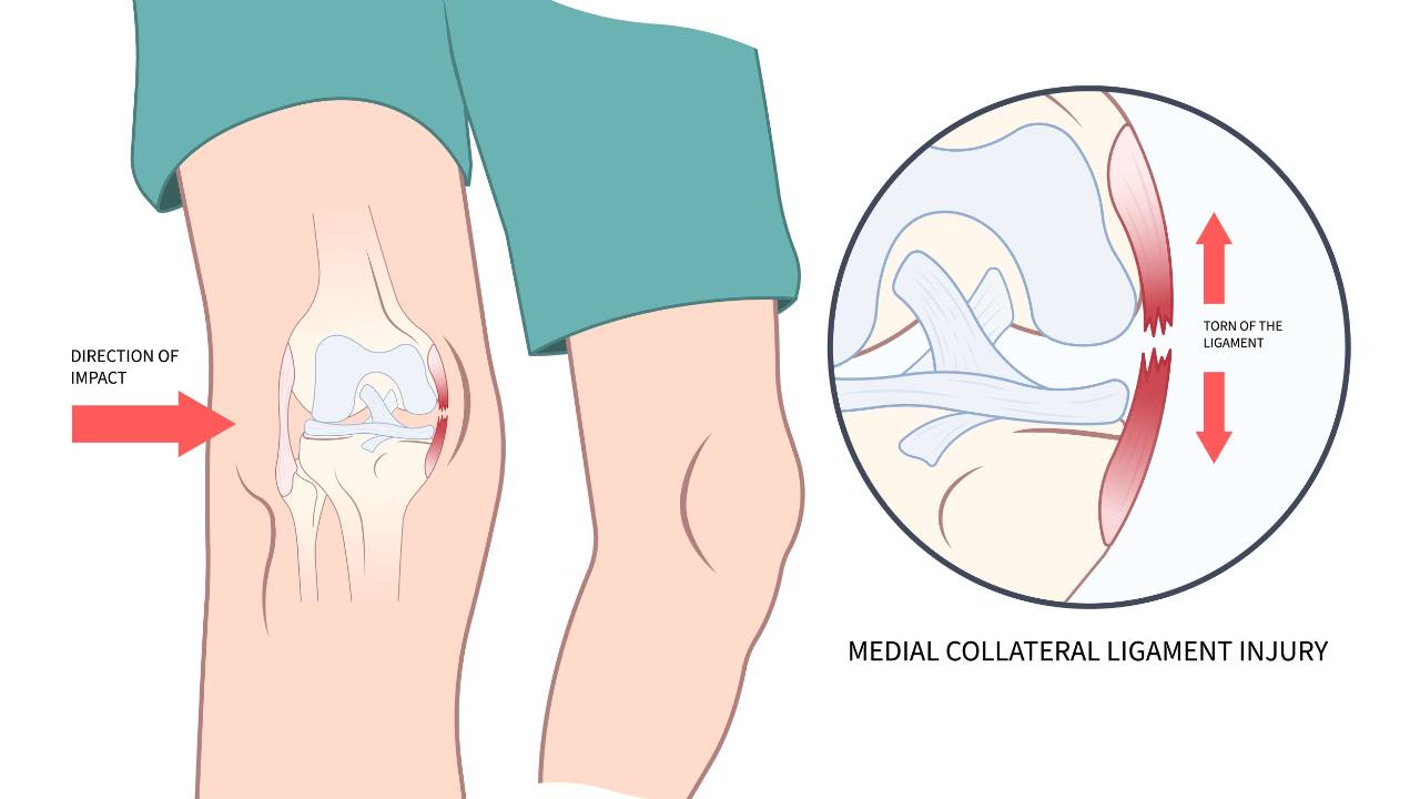 Does PRP Help Heal MCL Tears?