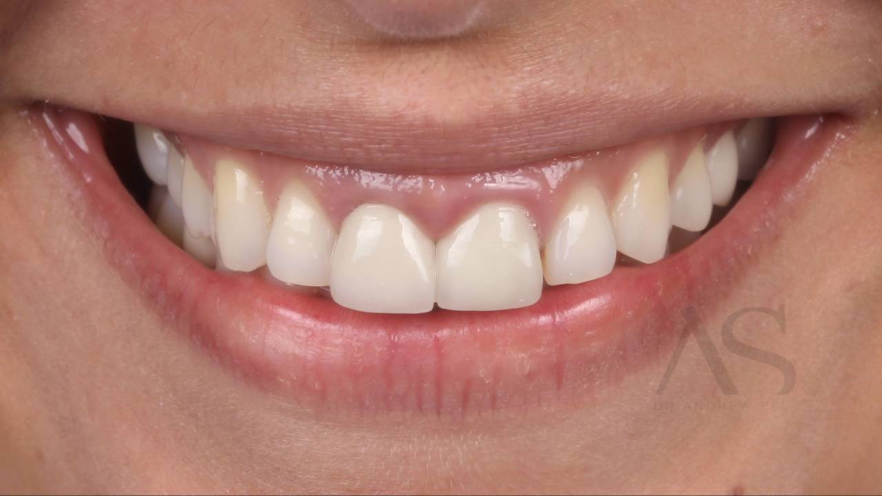 Crack The Code To Nail The Right Tooth Size Every Time