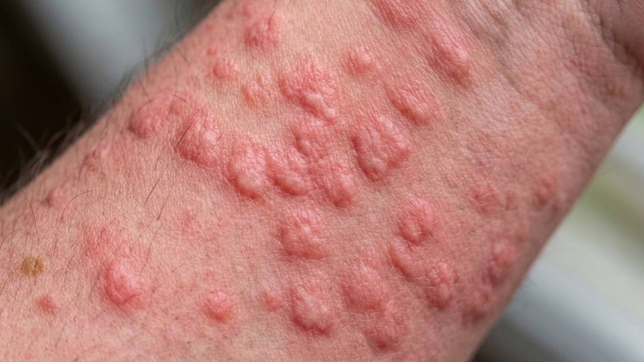 Skin on an arm with raised bumps heavily covering the skin