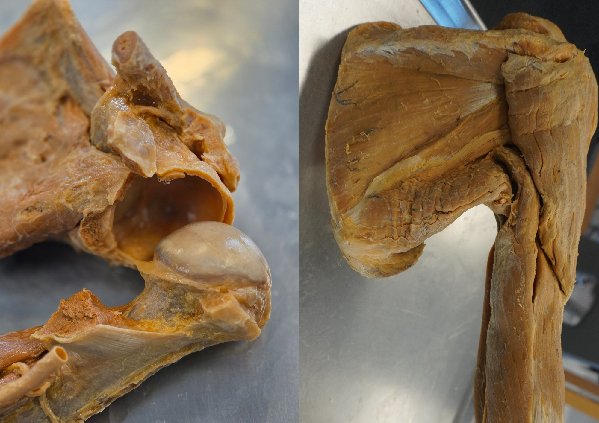 Side-by-side cadaveric medical comparison of a human shoulder dissection showcasing an open glenohumeral joint cavity alongside intact rotator cuff musculature.