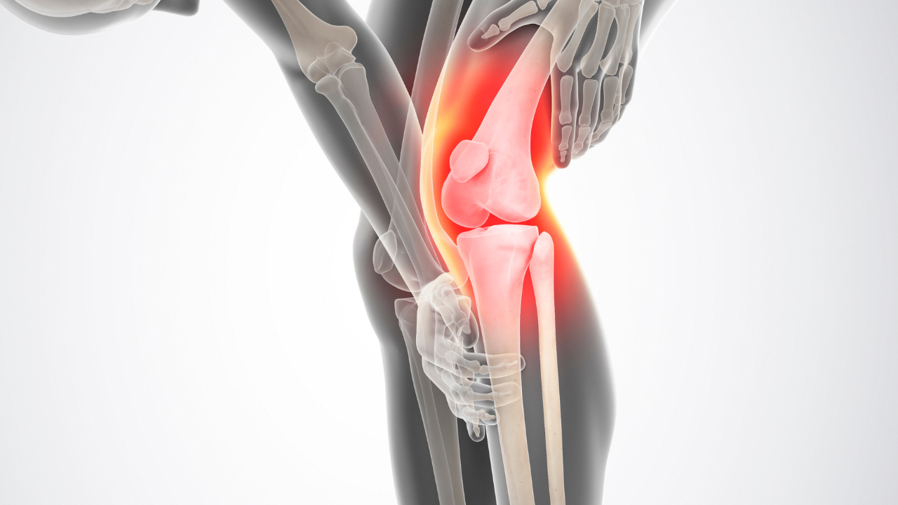 A medical 3D cross-section illustration of a human knee joint isolating the internal skeletal structure, with a bright red highlight indicating a severe anterior cruciate ligament, or ACL, sprain and fiber tear deep inside the joint.