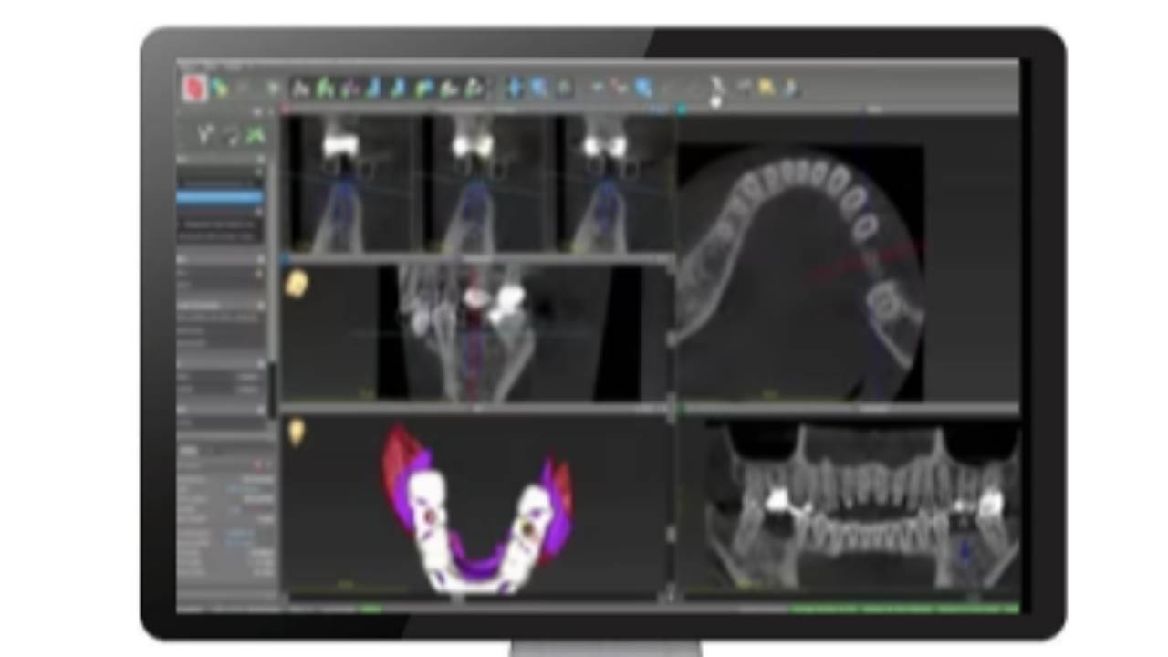 Choosing coDiagnostiX as your dental treatment planning software