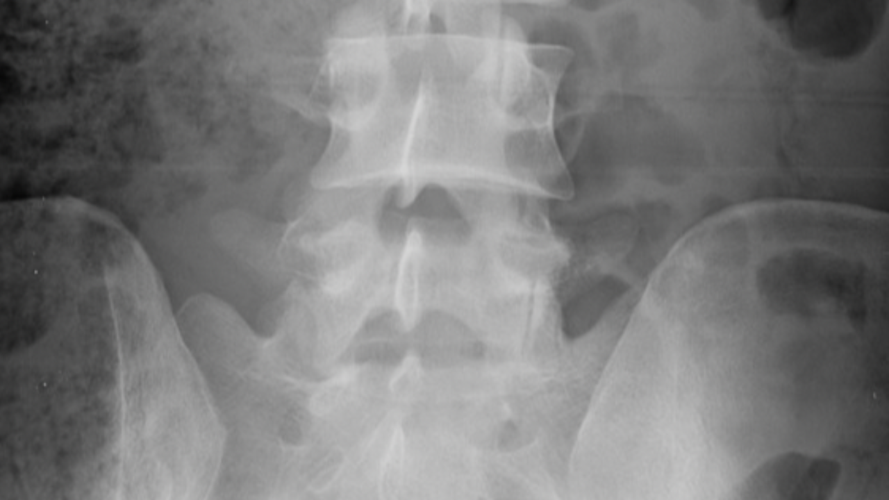 lumbar spine x-ray