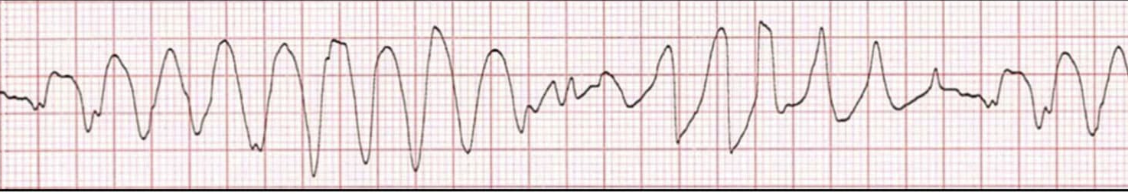 ECG rhythm strip