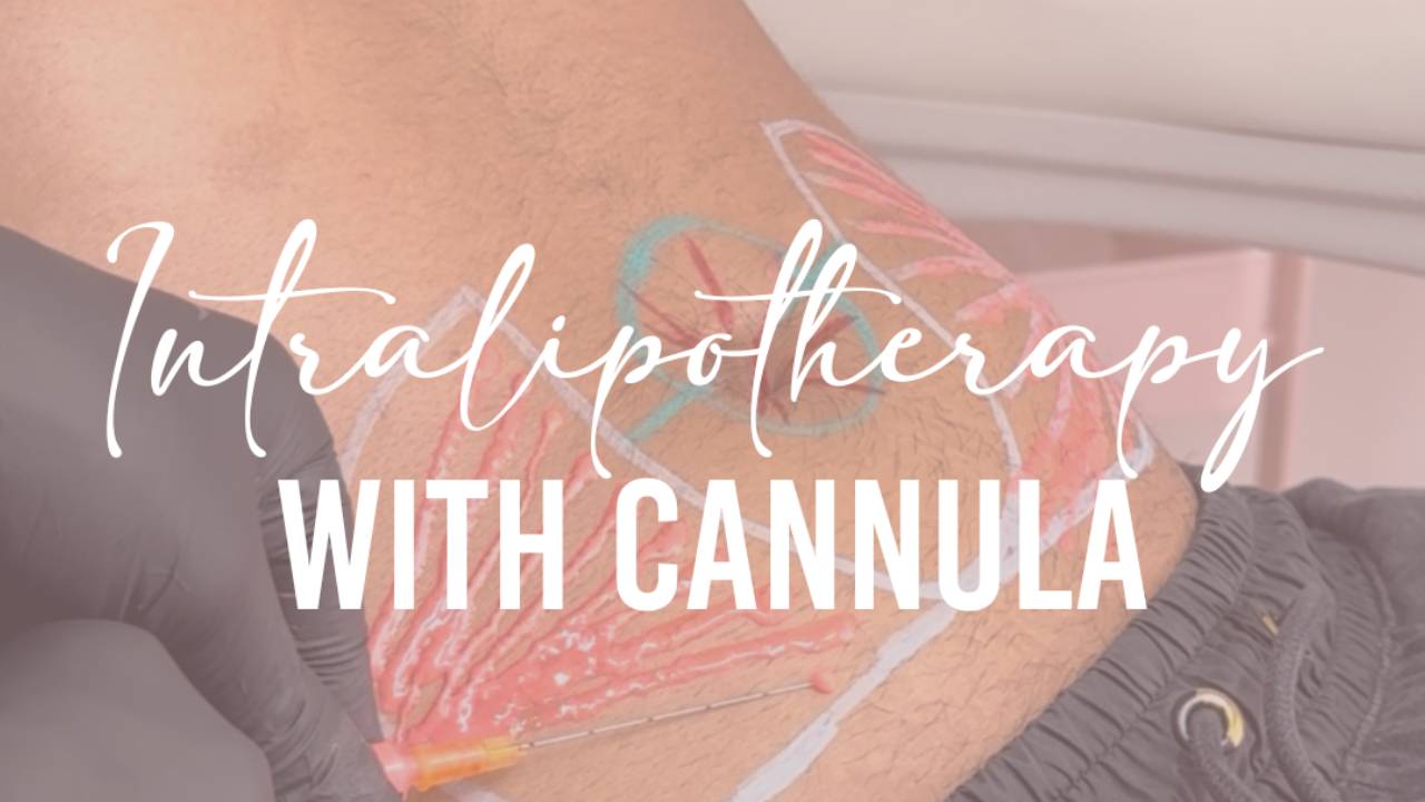 Online Intralipotherapy with Cannula