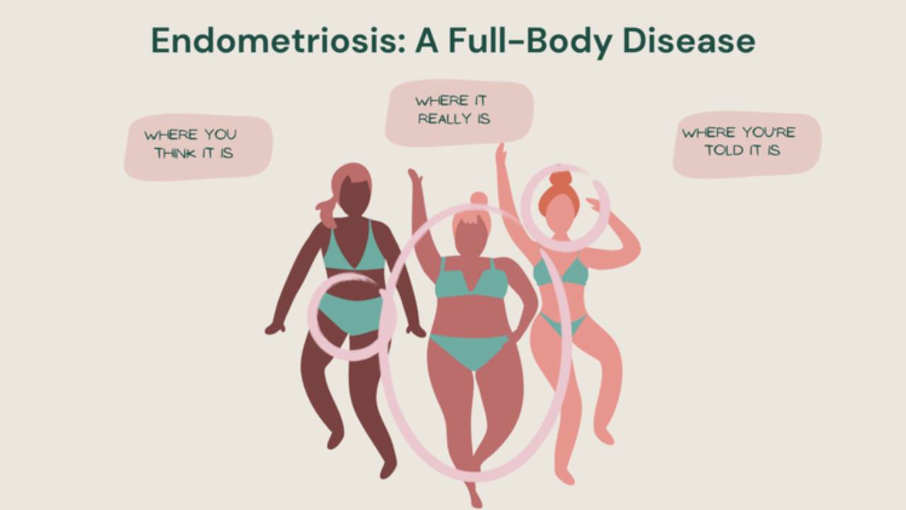 Endometriosis and Immune Dysfunction