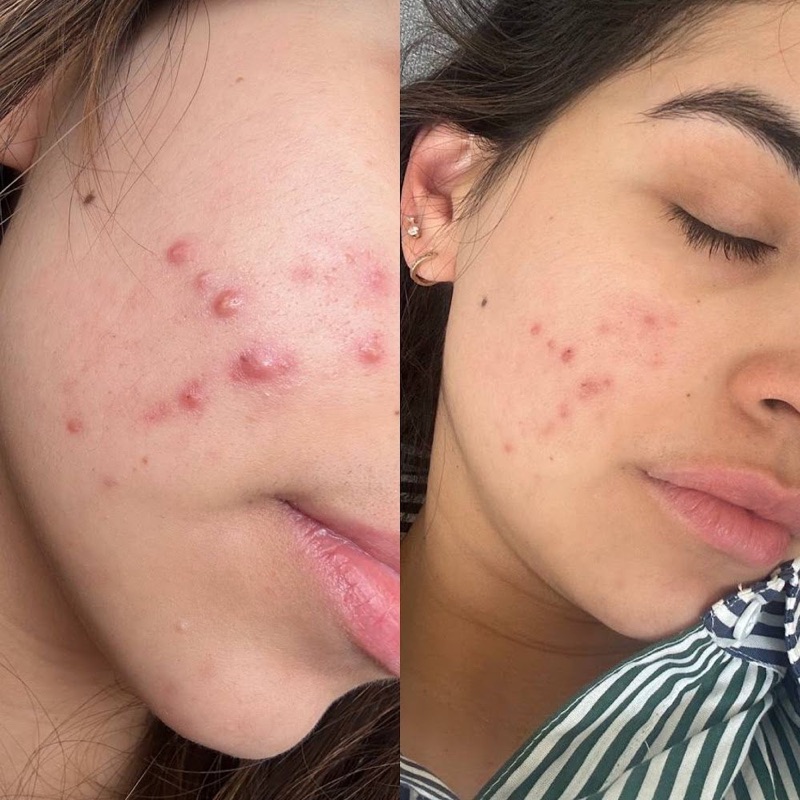 Antes y después real: Acné