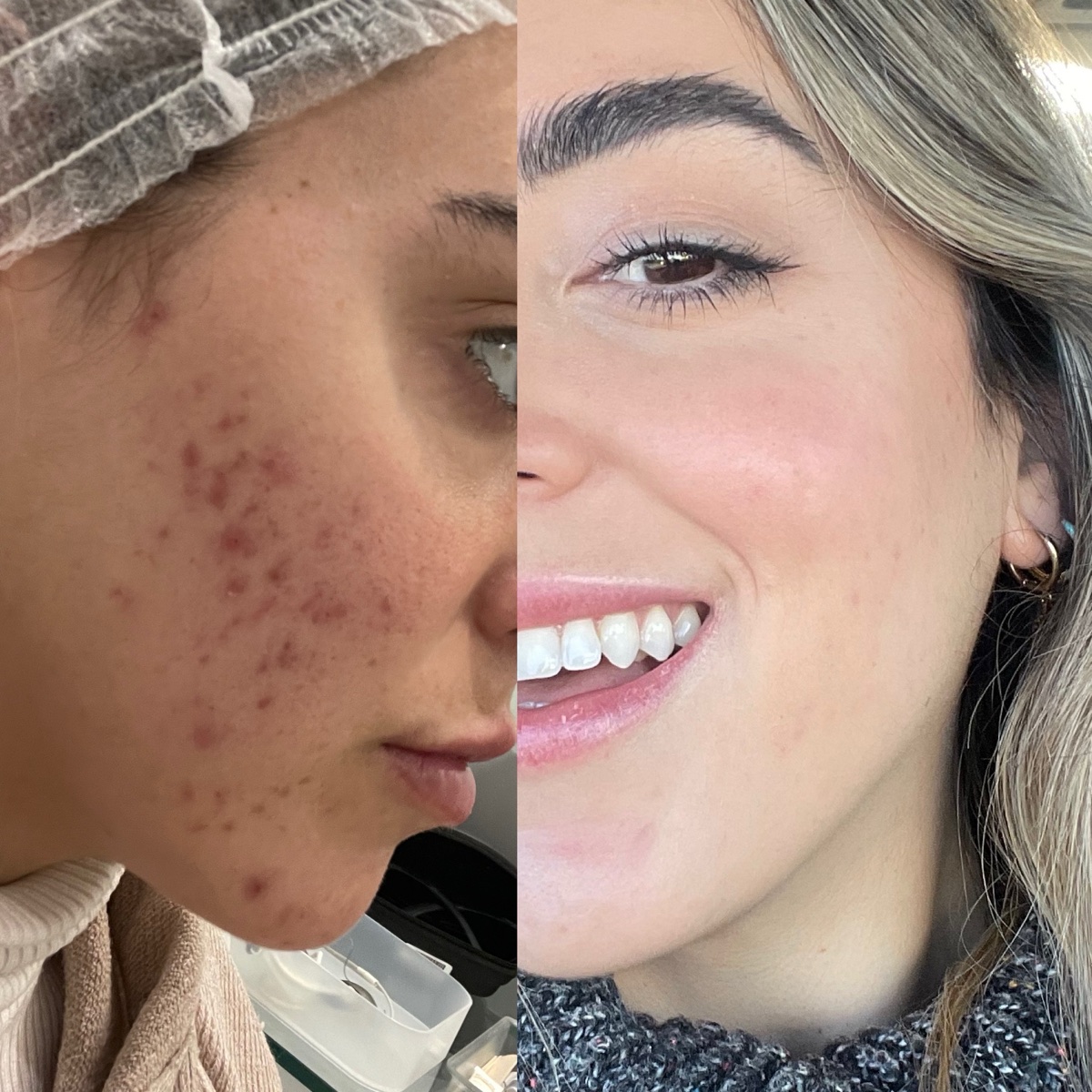 Antes y después real de la piel de Gaby