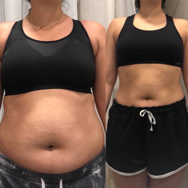 Antes y después real: Abdomen