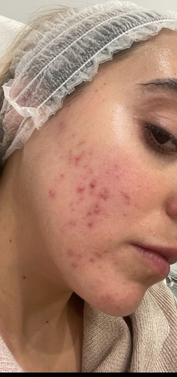 Foto real de Gaby con acné
