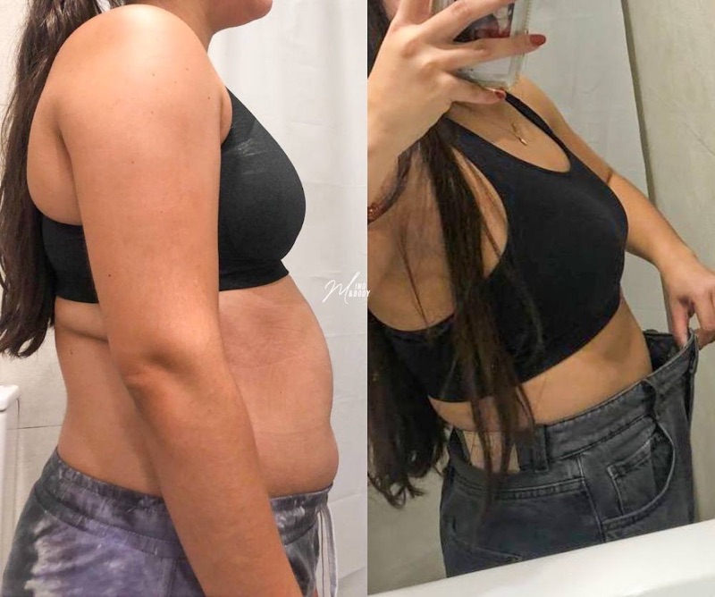 Antes y después real: Abdomen de perfil