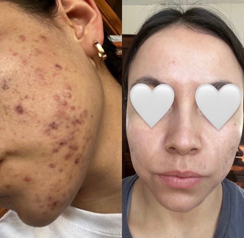 Antes y después real: Acné quístico