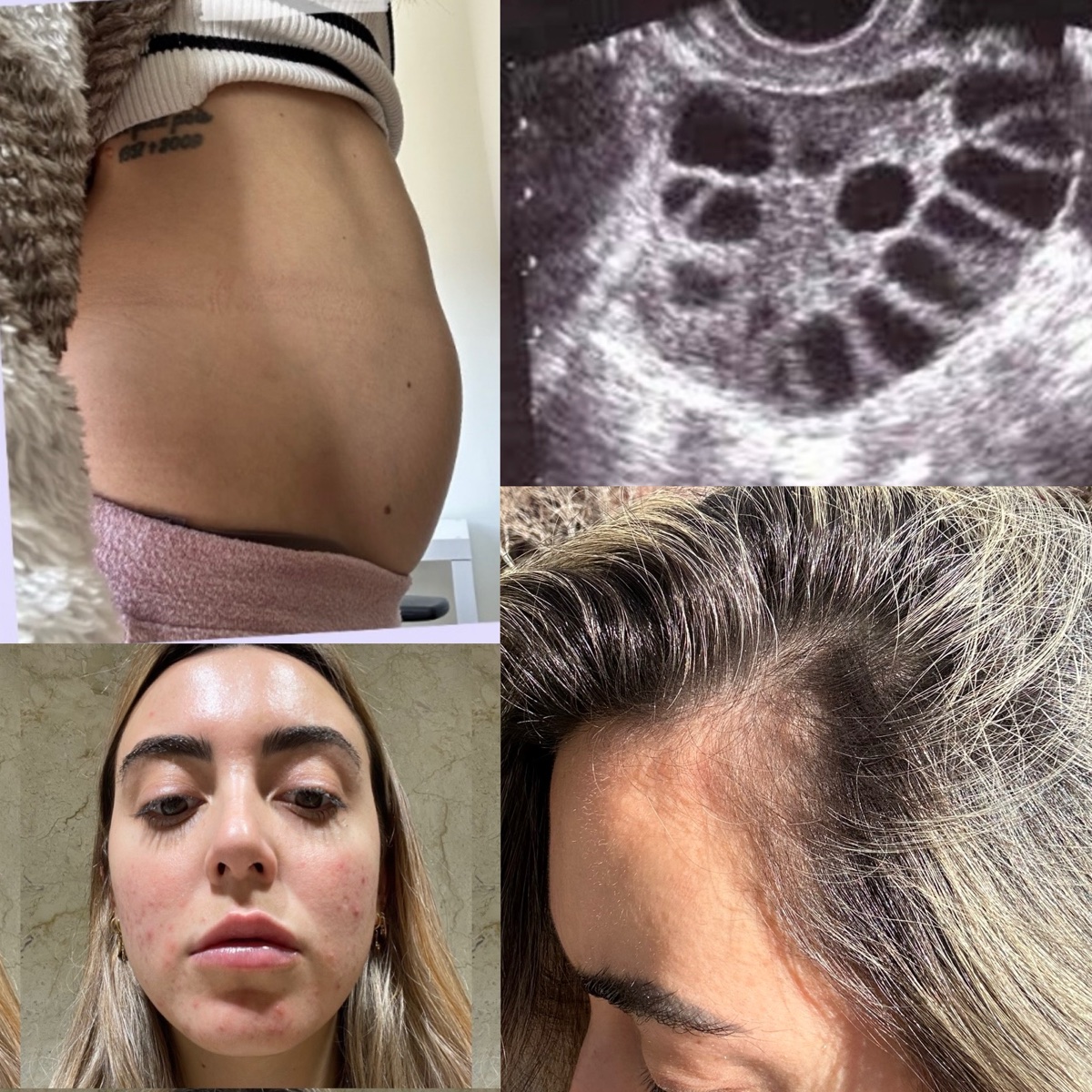 Fotos reales de Gaby con síntomas de SOP: abdomen inflamado, ecografía, acné y caída de pelo