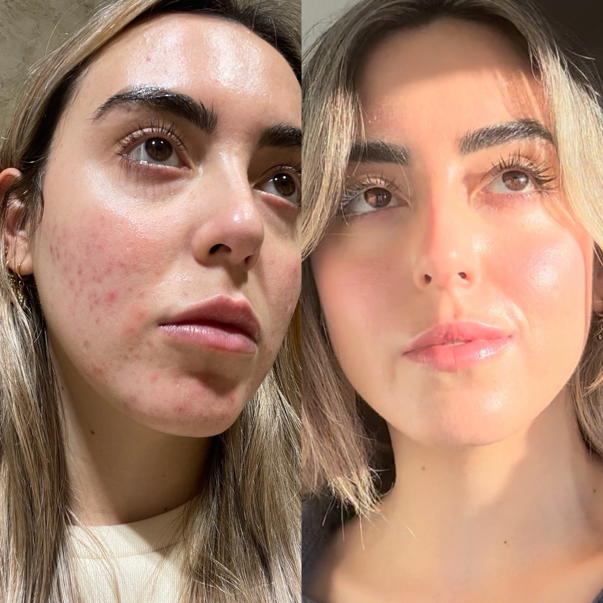 Antes y después real de la piel de Gaby