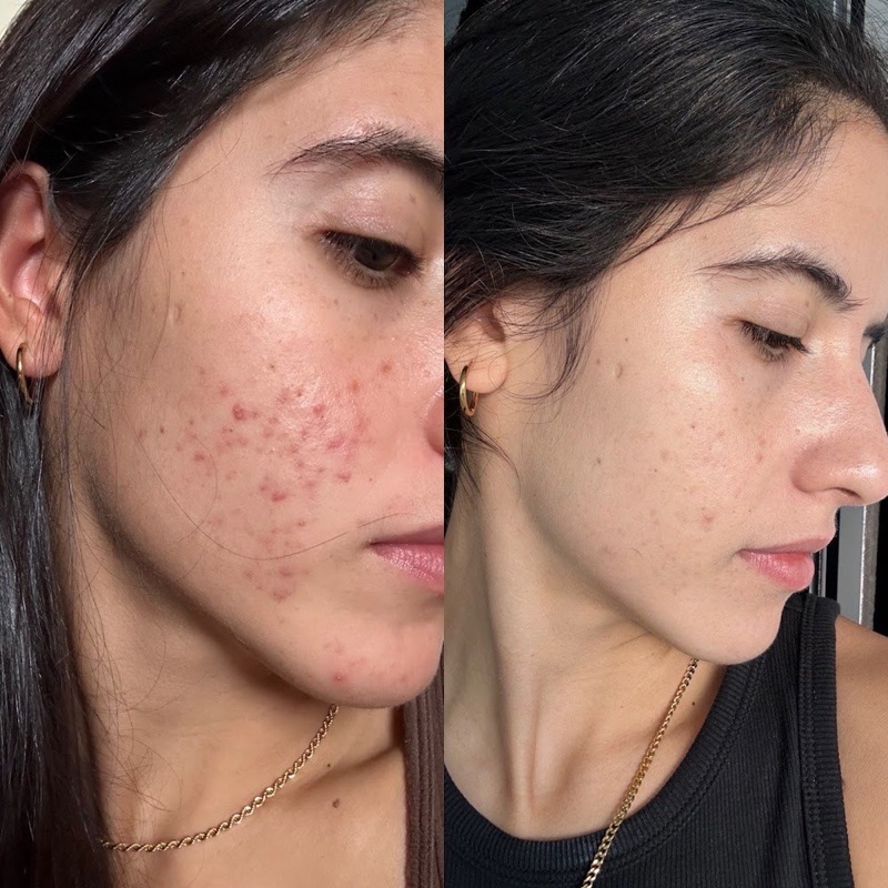 Antes y después real: Acné