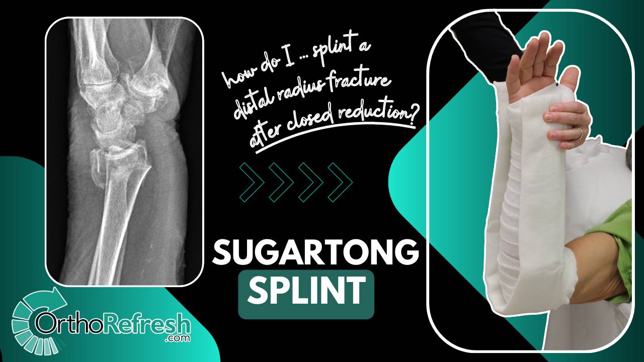 Distal Reduction How to perform closed reduction & splinting of Distal Radius Fracture