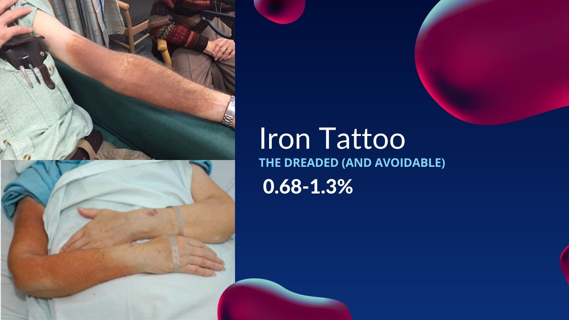 Adverse Iron infusion Events