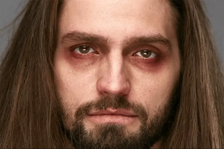 Before and after: dark circles and redness removed, skin texture intact