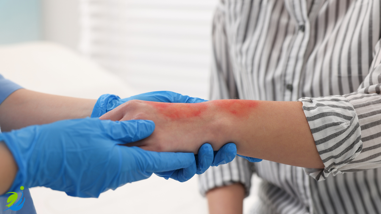 Close-up of a worker’s arm with visible burn injury being examined by a medical professional wearing gloves, representing common workplace injuries in restaurant environments and the importance of safety documentation.