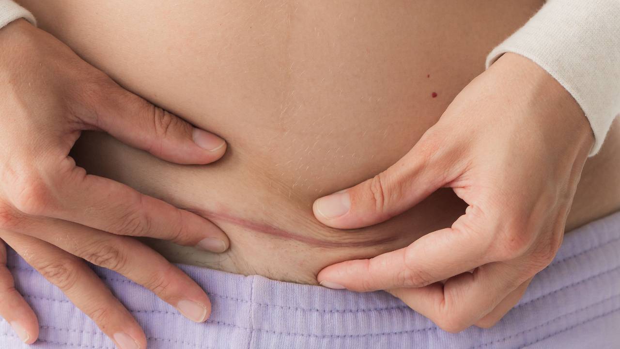 Cicatrice de césarienne sur le bas-ventre d'une nouvelle maman en récupération post-partum