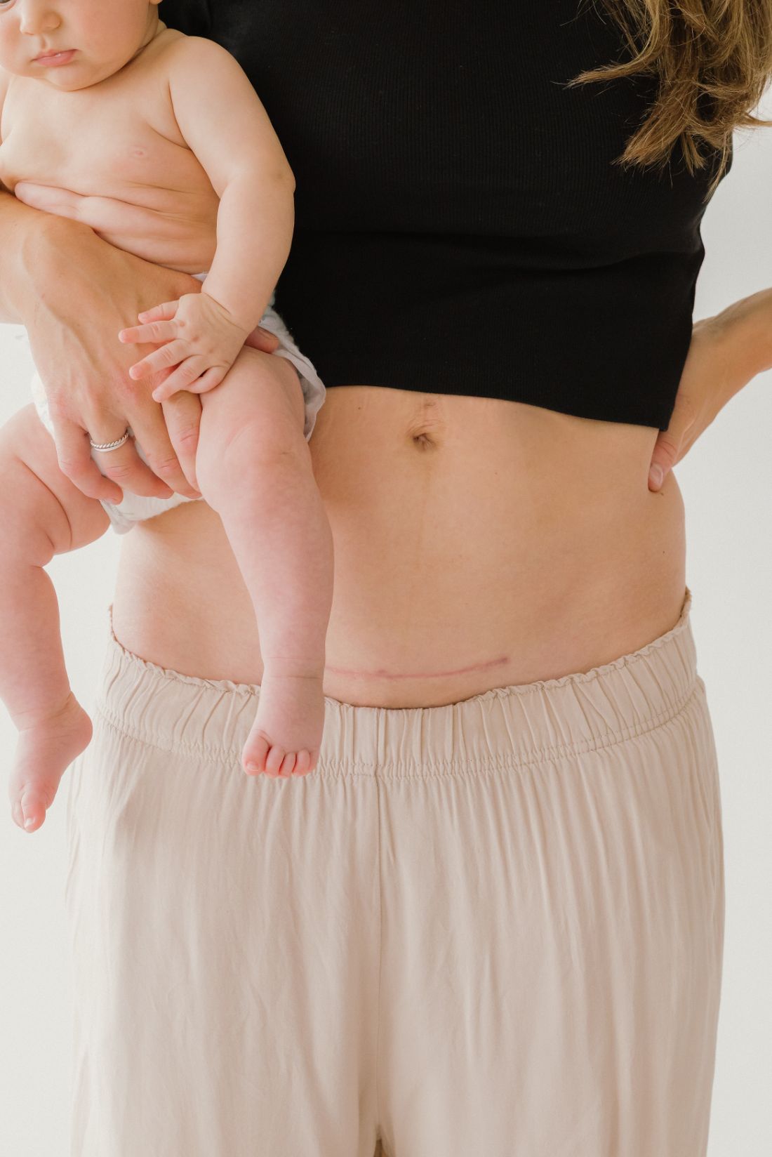 Maman qui tient son bébé, cicatrice de césarienne visible – récupération post-césarienne avec une physio périnéale
