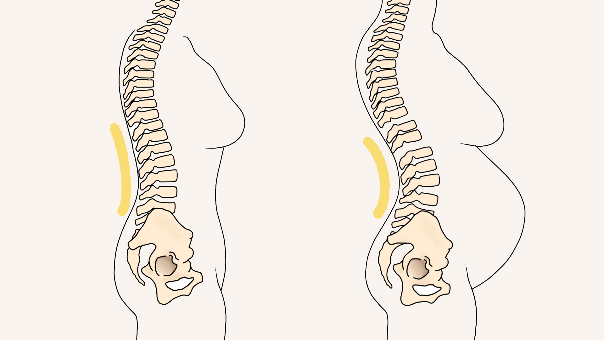Illustration comparing spinal alignment before and during pregnancy, showing how the lumbar curve deepens and the pelvis tips forward as the belly grows