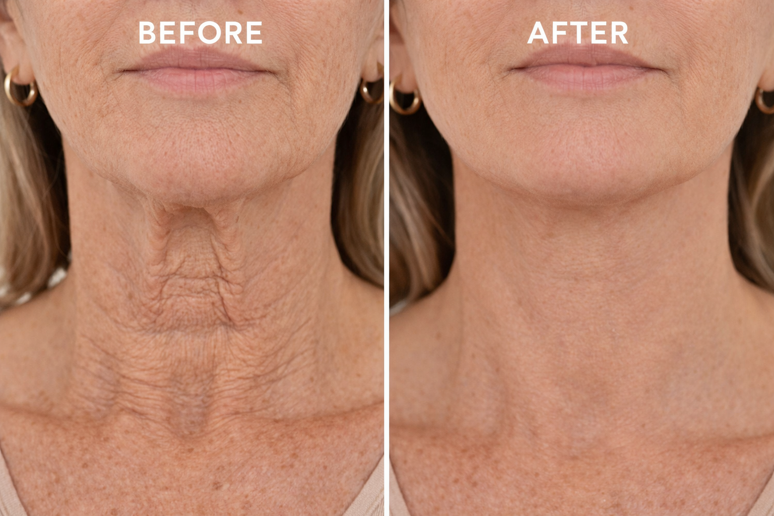Neck before and after results