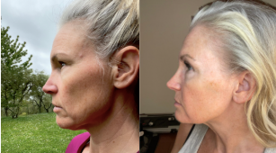 Liz, side profile before and after