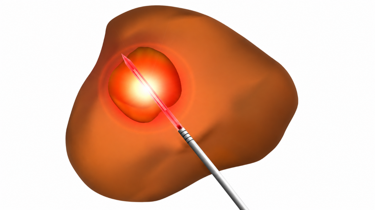 Image of the prostate with focal therapy treatment
