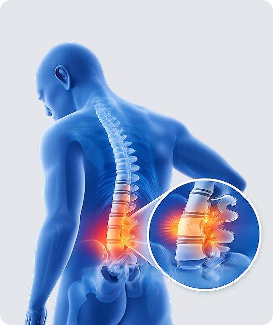 Spinal Stenosis
