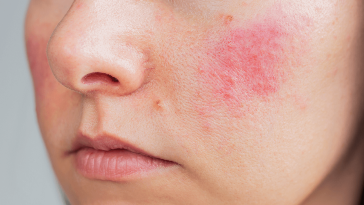 Sensitive and Rosacea Care Seminar