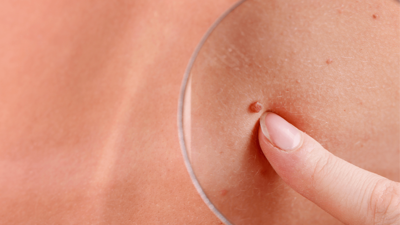 Skin Cancer: Effective Prevention