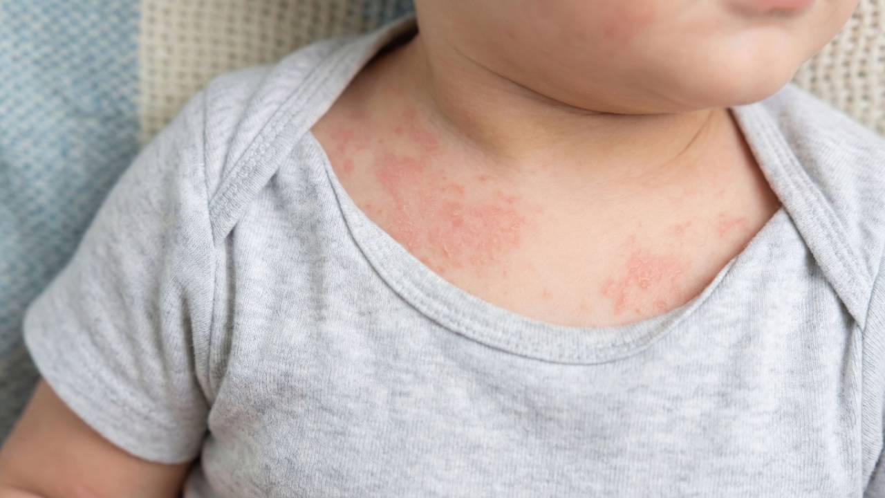Child with eczema