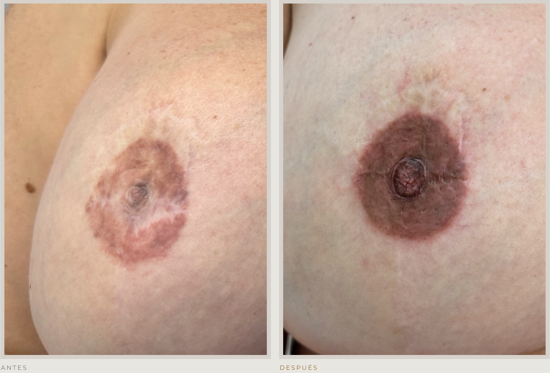 Imagen clínica de reconstrucción de areola