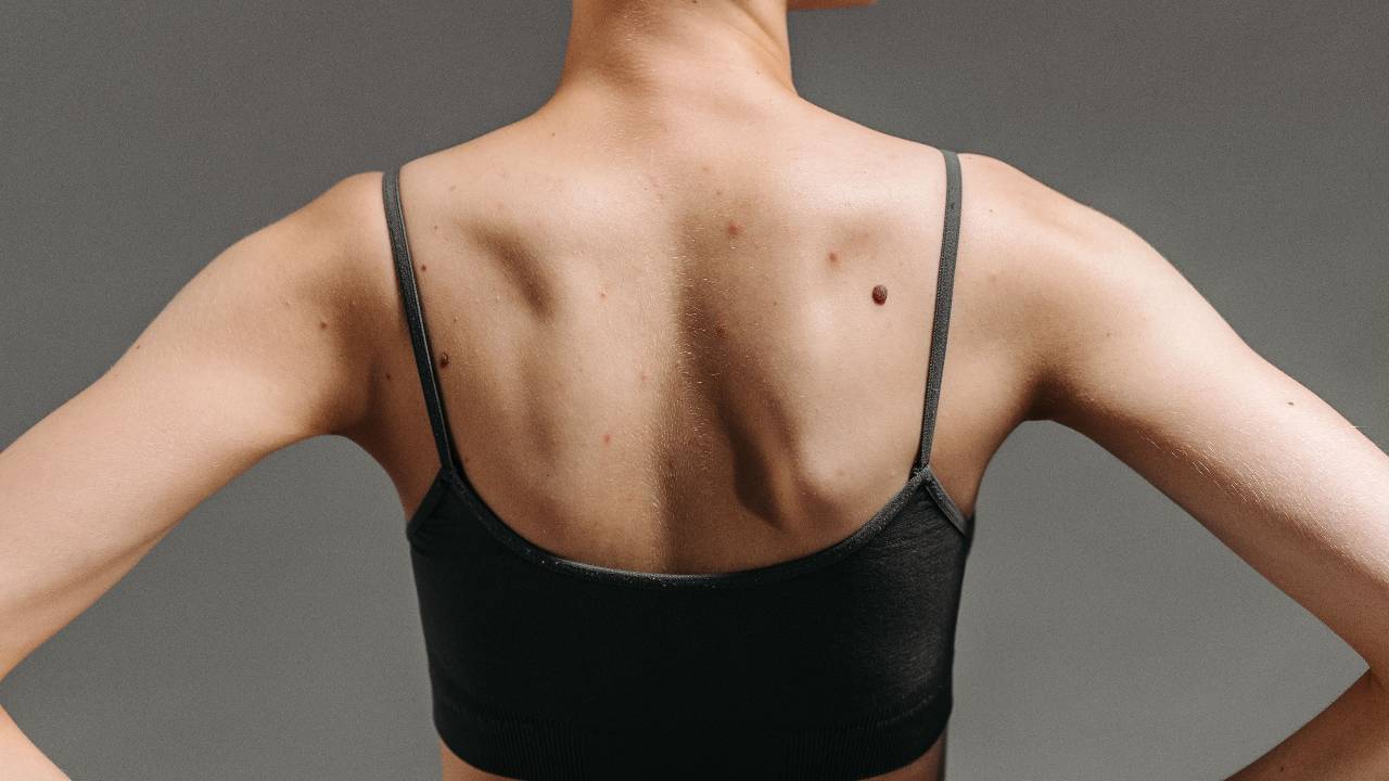 Pilates for scoliosis