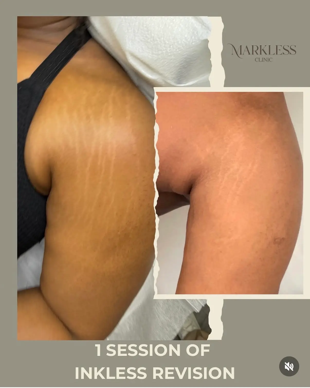 Inkless Stretch Mark Revision