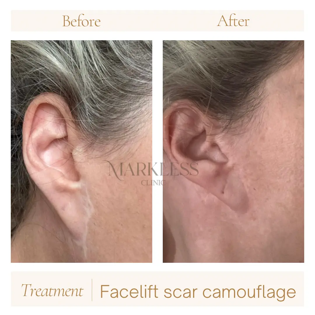 Scar Camouflage