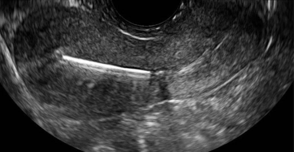 Ovēa IUD scan review photo